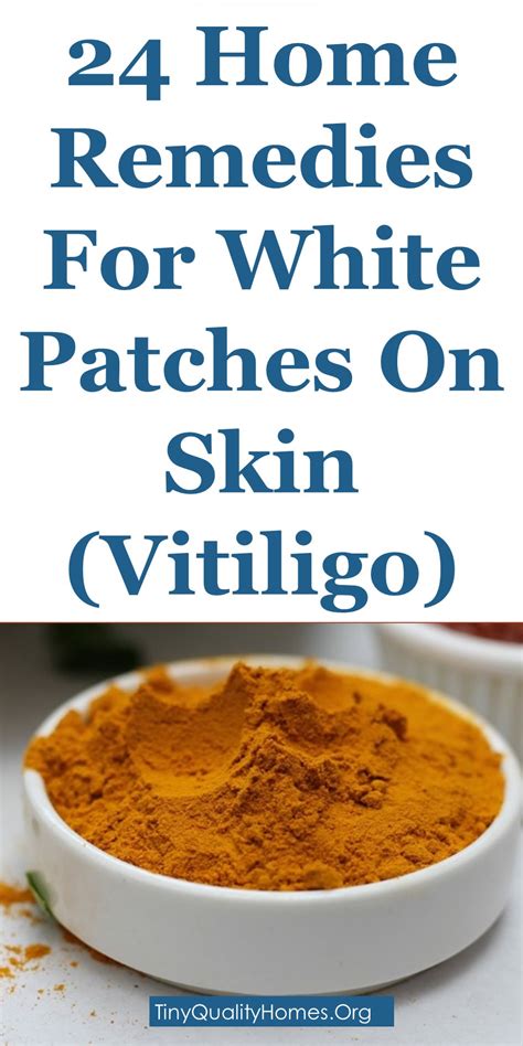 24 Home Remedies For White Spotspatches On Skin Vitiligo