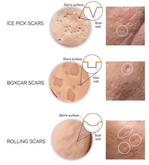 (acne scar) scars due to severe acne. "Why is Your Acne Scar Treatment Not Working?" By Dr Wu ...