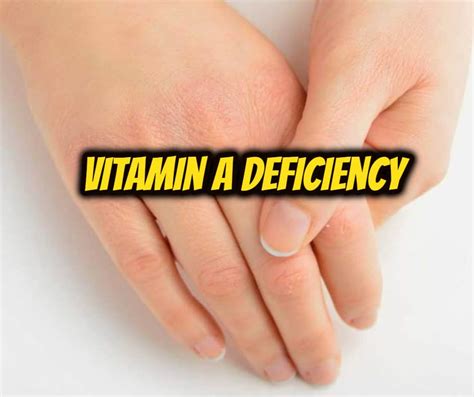 Vitamin A Deficiency विटामिन ए की कमी के बारे में