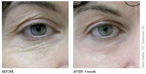 Your favorite laser clinic is right here! Laser Hair Removal | Laser Resurfacing | Palo Alto CA ...