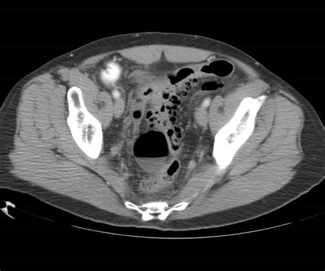 Diverticulitis With Perforation And Abscess Colon Case Studies
