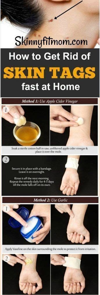 Till then, keep maintaining oral. How to Remove Skin Tags Fast and Safely at Home - Proven ...