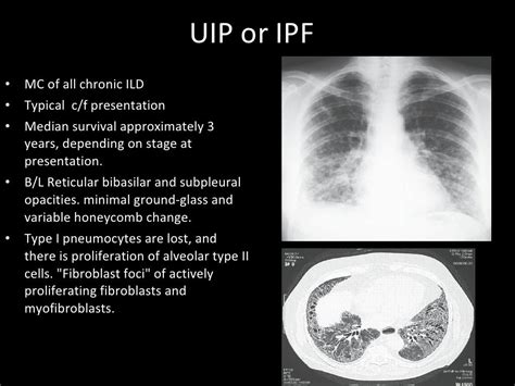 Interstitial Lung Disease