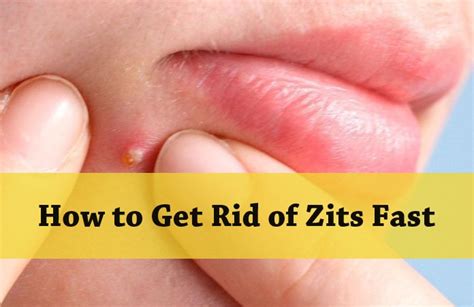19 Surefire Home Remedies On How To Get Rid Of Zits Fast
