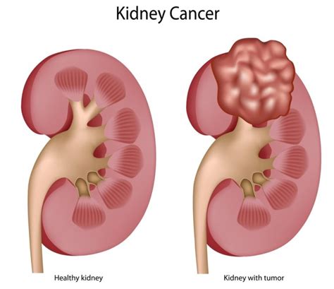 Renal Cell Carcinoma Symptoms Causes Treatment