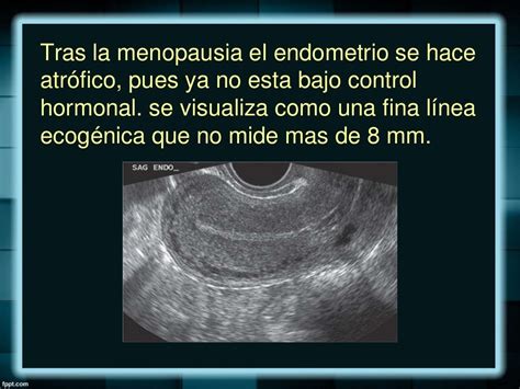 Eco Endometrial Presente Bem Delimitado Regular Linear E Fino
