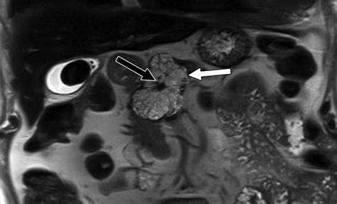 Pancreatic Calcifications And Calcified Pancreatic Masses Pattern