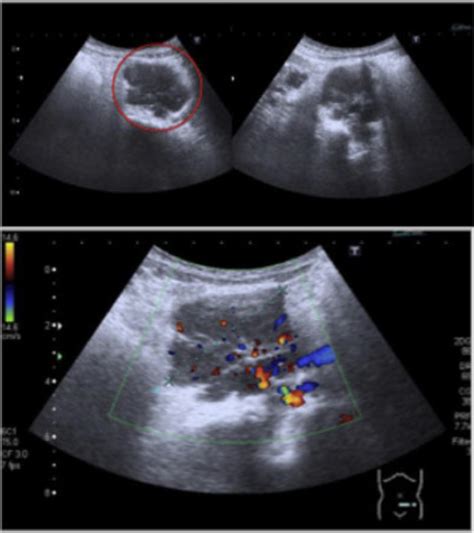 Abdominal Ultrasound Scan Of The Abdomen Private Scans Ultrasound My
