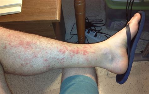 Hikers Rash Red Rash Between Knee And Ankle After Hiking For Several