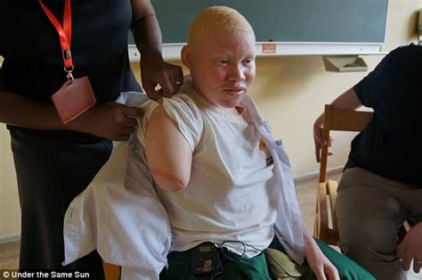 Albino Womans Arm Was Cut Off With A Machete To Sell To Tanzanian