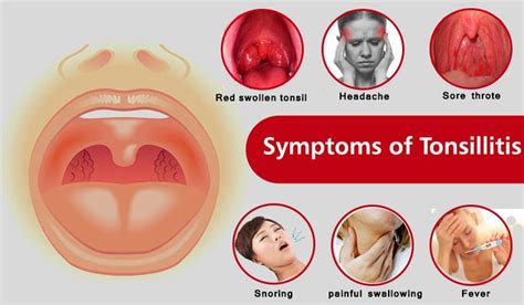 Tonsil cancer presents as a mass, ulcer or swelling of the tonsil. 6 Best Homeopathic Medicines for Tonsillitis Treatment ...