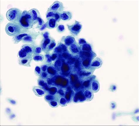 Transitional Cell Carcinoma High Grade Voided Urine Papanikolaou