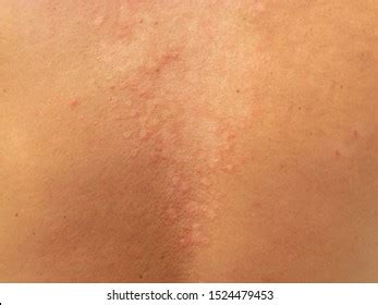 Pityriasis Versicolor Tinea Versicolor Skin Disease Stockfoto Shutterstock