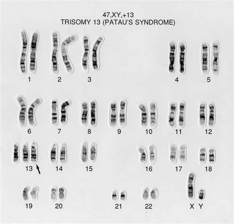 Human Karyotype Of Patau Syndrome Autosomal Abnormalities Trisomy The