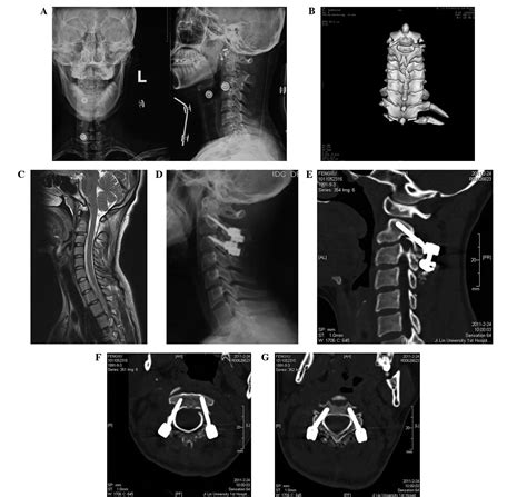 One‑stage Posterior C2 And C3 Pedicle Screw Fixation Or Combined