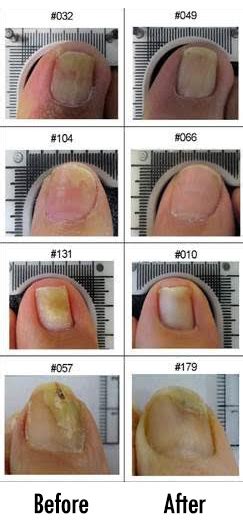 Update Is Fungal Nail Infection Contagious Super Hot