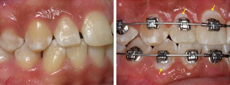White Spots On Teeth After Orthodontics Biomin Toothpaste