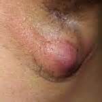 Photos of Home Remedies For Large Boils