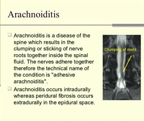 7 Best Arachnoiditis An Insidious Incurable Disease Of The Spine And
