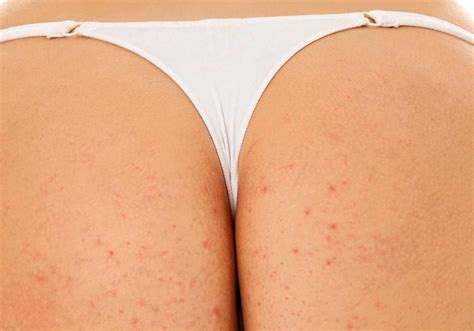 Scratching is not one of the ways of how to get rid of spots on your bum but most people with this condition always do it. Pimples on buttocks - How to get rid of them - Best Acne ...