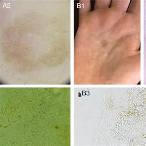 Two Cases Of Tinea Nigra With Classic Clinical Presentation A B Download Scientific