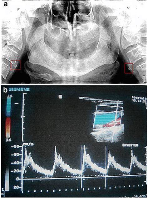 A Bilateral Carotid Artery Calcifications B Measurements Of Psv And