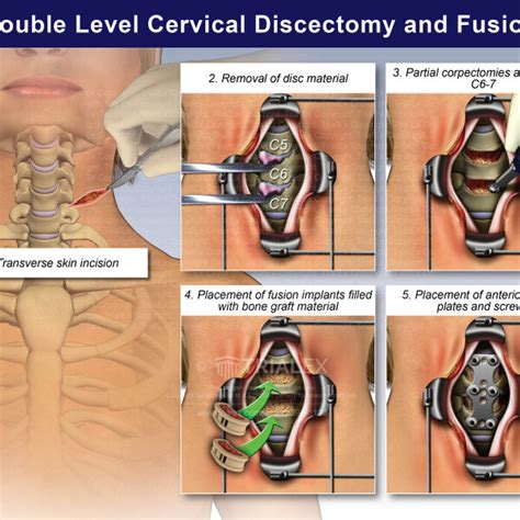 Double Level Cervical Discectomy And Fusion Trialexhibits Inc