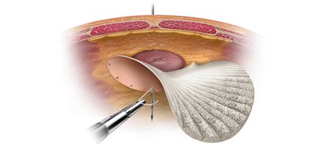 How Is The Use Of Mesh Helpful During A Hernia Surgery Neoalta