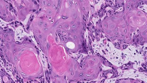Squamous Cell Carcinoma Pathology Dictionary Mypathologyreportca