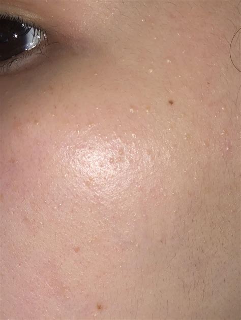 Bumpy Texture On Face