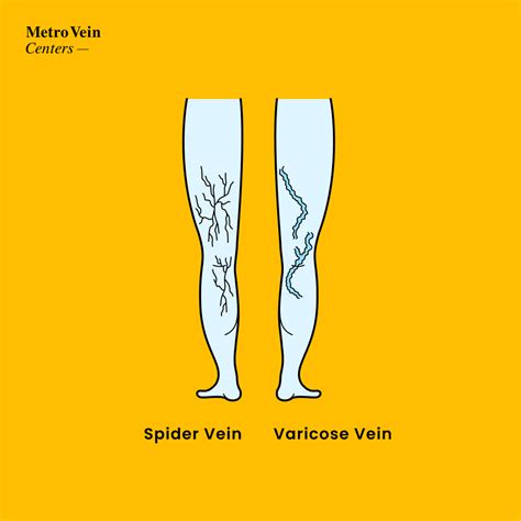 Are Spider Veins And Varicose Veins The Same Thing Metro Vein Centers