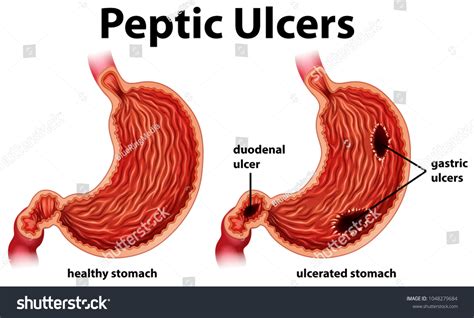 Peptic Ulcer Anatomy Stock Vector Royalty Free 1048279684 Shutterstock