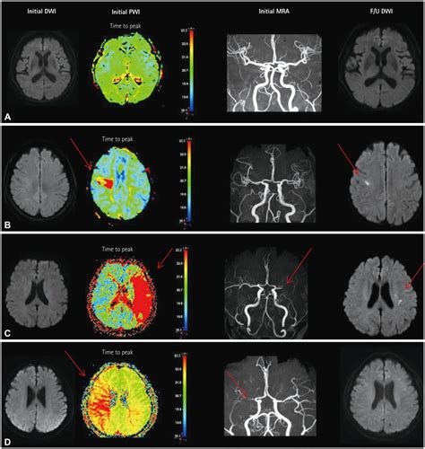Role Of Perfusion Weighted Imaging In A Diffusion Weighted Imaging