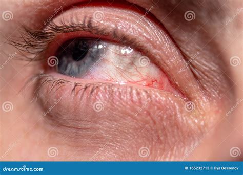 Red Capillaries Of An Inflamed Eye Near Stock Image Image Of