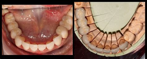 Lower Anterior Teeth