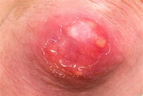 Mesh includes the subject headings. Boils on the buttocks: Causes, treatment, and symptoms
