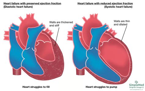 Heart Failure Simplemed Learning Medicine Simplified