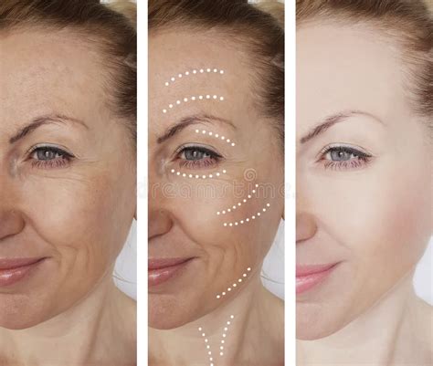 Female Wrinkles Removal Before After Procedure Results Regeneration