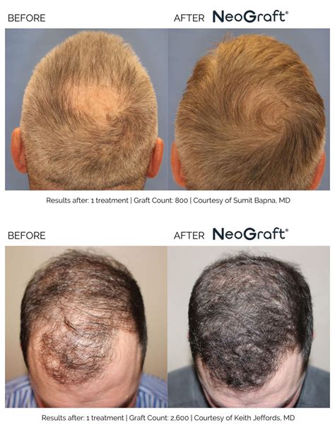 NeoGraft Hair Transplant FUE Hair Restoration In Westport CT