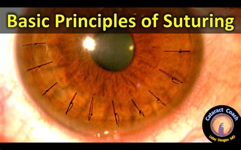 Basic Principles Of Ophthalmic Suturing Cataract Coach