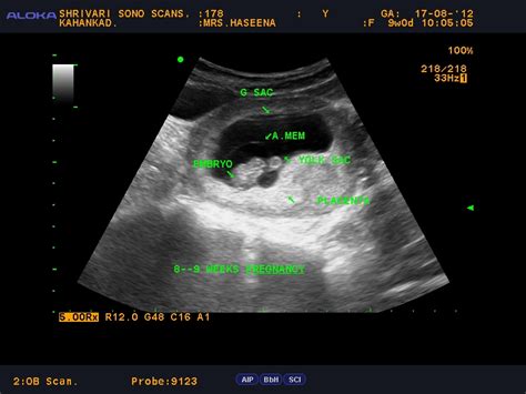Shrivari Sono Scans Biology Of Prenatal Devalopment 8 9 Weeks Pregnancy