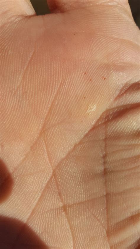 Why Do I Have Red Spots On The Palm Of My Hand Quora