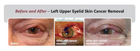 Eyelid And Facial Skin Cancer Triad Eye Institute