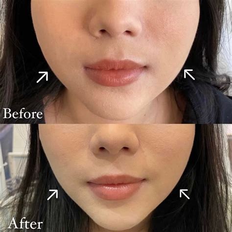 Masseter Botox Can Botox Be Used For Face Slimming