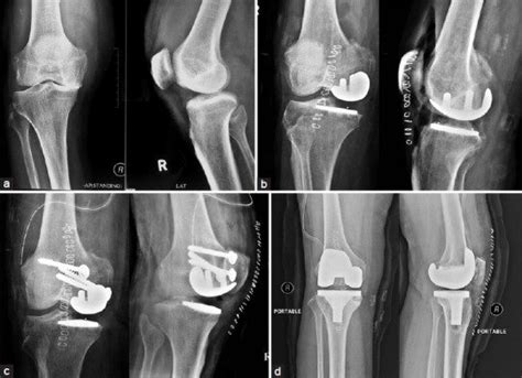 A Preoperative X Ray Anteroposterior And Lateral Views Of R Knee