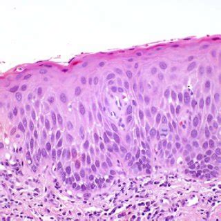 Vulvar High Grade Squamous Intraepithelial Lesion The Lesion Shows