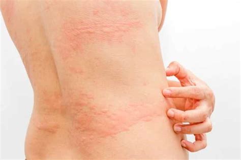 Allergic Reaction To Scabies Rash Pictures Types Of Rashes Rashes