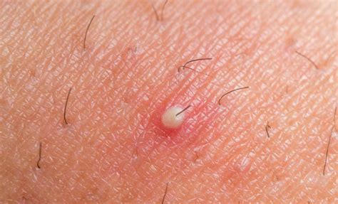 White Dotsbumps On Skin Causes And Treatment