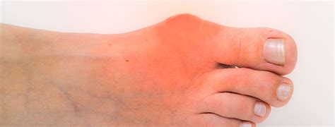 Gout Treatment And Gout Attack Pain Relief Northwest Indiana Podiatrist