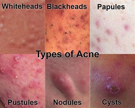 Here Is Everything You Need To Know About Curing Acne And More The